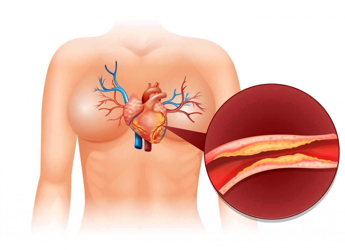 ภาพจำลองร่างกายส่วนบน แสดงลักษณะบริเวณหัวใจและหลอดเลือด กับภาพขยายที่มองเห็นไขมันคอเลสเตอรอลเกาะตามผนังหลอดเลือด